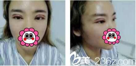 上海德琳医疗美容医院宋鸿植双眼皮真人案例术后天
