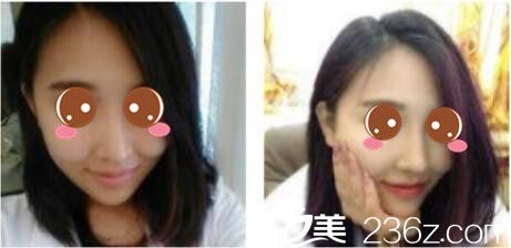 上海德琳医疗美容医院宋鸿植鼻综合真人案例术后十五天