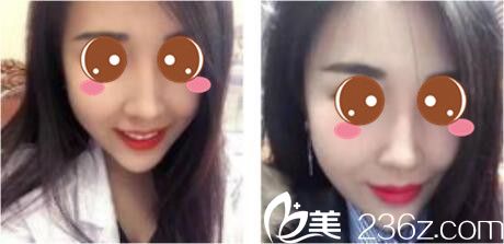 我的鼻子是在上海德琳找宋鸿植做的鼻综合，一个月就恢复美美哒