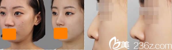 深圳富华整形美容鼻综合案例对比图