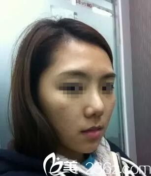 南宁美丽星做丰太阳穴+脸颊自体填充手术