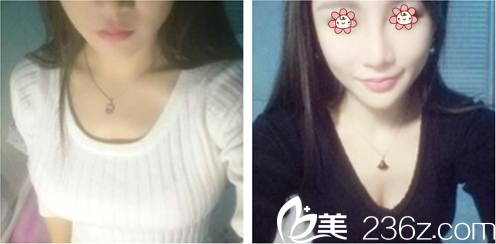 张宝誉假体隆胸术后半个月 张宝誉假体隆胸术后半个月