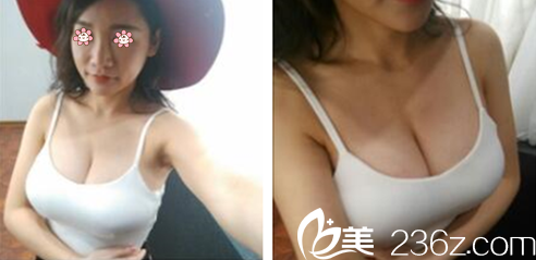 乌鲁木齐伊丽莎白整形假体丰胸术后一个月 乌鲁木齐伊丽莎白整形假体丰胸术后一个月