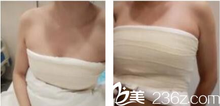 上海东方丽人医疗美容门诊部乔海初假体隆胸真人案例术后第三天