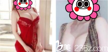 好闺蜜说上海东方丽人乔海初做假体隆胸不错，看我做完三个月的恢复效果图