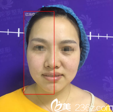体验无锡曼陀罗口碑项目：Fotona 4D紧美人面部抗衰除皱后，给你看半边脸的即刻效果对比
