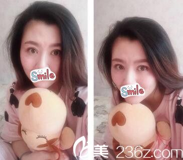 洛阳爱尚双眼皮手术后2个月 洛阳爱尚双眼皮手术后2个月