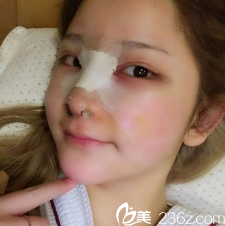 来广州星团找黄立斌刚做完隆鼻的图片 来广州星团找黄立斌刚做完隆鼻的图片