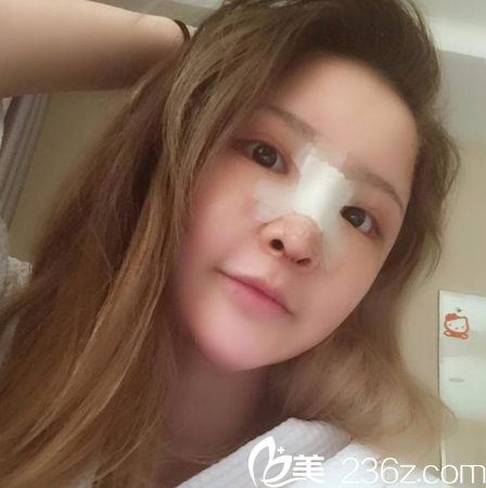 找广州星团黄立斌院长做完隆鼻三天恢复图片 找广州星团黄立斌院长做完隆鼻三天恢复图片