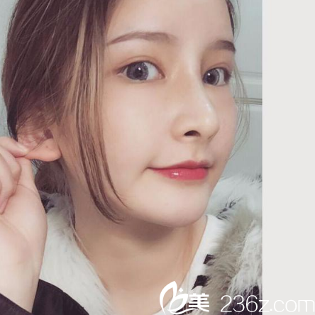 之前在广州星团整形医院做过双眼皮这次来找黄立斌院长做鼻综合隆鼻