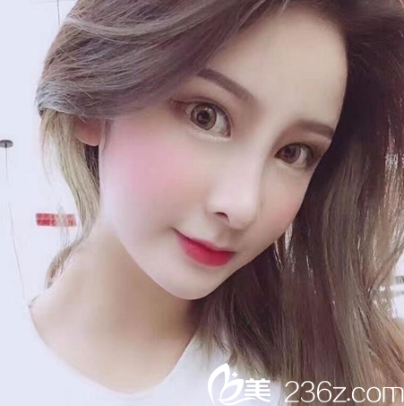 广州星团整形医院黄立斌鼻综合隆鼻案例两个月效果图 广州星团整形医院黄立斌鼻综合隆鼻案例两个月效果图