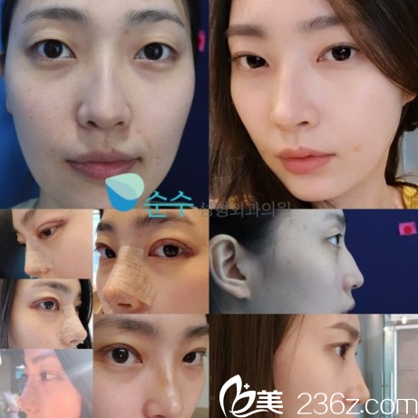 崔宰源院长双眼皮隆鼻效果好吗 崔宰源院长双眼皮隆鼻效果好吗