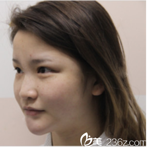 来广州星团找黄立斌院长隆鼻前的照片 来广州星团找黄立斌院长隆鼻前的照片