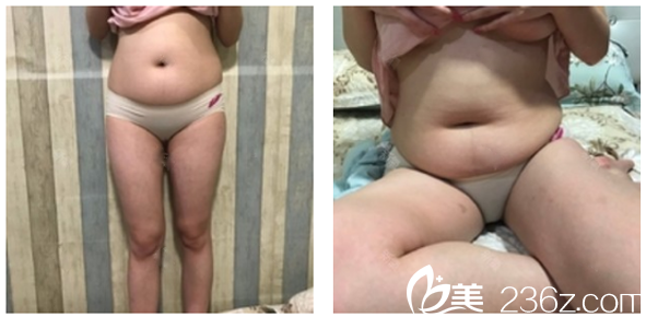 来广州星团整形医院做吸脂前的照片 来广州星团整形医院做吸脂前的照片