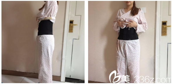 广州星团整形医院黄立斌吸脂术后效果图 广州星团整形医院黄立斌吸脂术后效果图