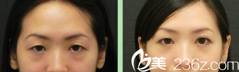 韩国Prima整形外科医院祛眼袋案例 韩国Prima整形外科医院祛眼袋案例