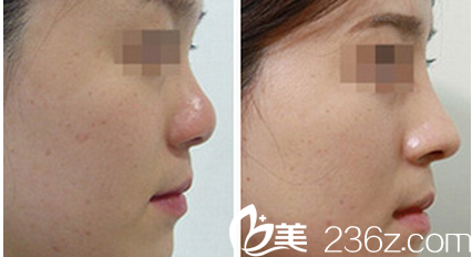 韩国Prima整形外科医院硅胶隆鼻效果 韩国Prima整形外科医院硅胶隆鼻效果