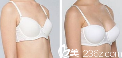 韩国Prima整形外科医院假体隆胸案例 韩国Prima整形外科医院假体隆胸案例