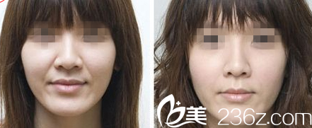 韩国Prima整形外科医院面部除皱效果 韩国Prima整形外科医院面部除皱效果