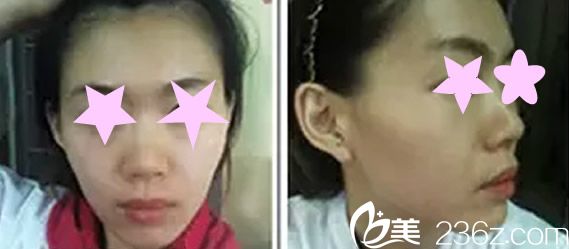 自体软骨隆鼻手术前照片