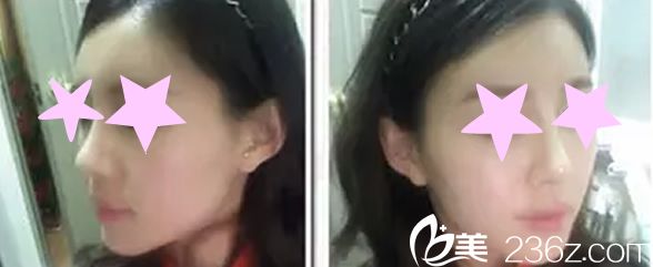 channel整形外科医院自体软骨隆鼻手术两个月后恢复效果