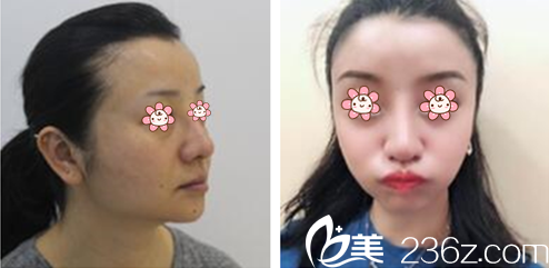 金仁哲院长面部轮廓案例 金仁哲院长面部轮廓案例