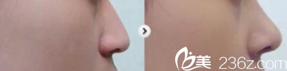 channel整形外科医院自体软骨隆鼻前后效果 channel整形外科医院自体软骨隆鼻前后效果