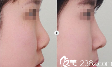 隆鼻手术案例对比图