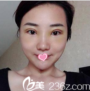 找马群做切开双眼皮和祛眼袋第11天<span style= 找马群做切开双眼皮和祛眼袋第11天<span style=