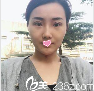 北京画美整形医院马群双眼皮祛眼袋<span style= 北京画美整形医院马群双眼皮祛眼袋<span style=