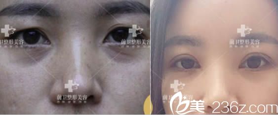 宜昌整形美容双眼皮效果对比图