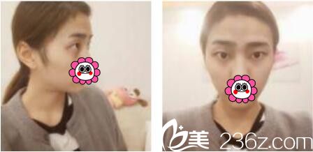 韩国娜美整形外科医院高惠园眼综合真人案例术前照 韩国娜美整形外科医院高惠园眼综合真人案例术前照