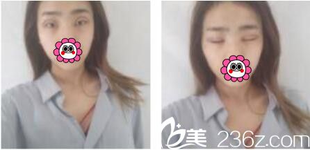 韩国娜美整形外科医院高惠园眼综合真人案例术后第三天 韩国娜美整形外科医院高惠园眼综合真人案例术后第三天