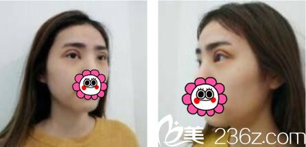 韩国娜美整形外科医院高惠园眼综合真人案例术后第七天 韩国娜美整形外科医院高惠园眼综合真人案例术后第七天