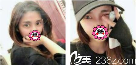 韩国娜美整形外科医院高惠园眼综合真人案例术后二十一天 韩国娜美整形外科医院高惠园眼综合真人案例术后二十一天