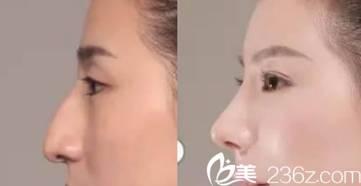 贵阳美贝尔整形医院假体隆鼻案例图 贵阳美贝尔整形医院假体隆鼻案例图