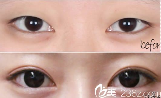 贵阳美贝尔医疗美容双眼皮案例图 贵阳美贝尔医疗美容双眼皮案例图