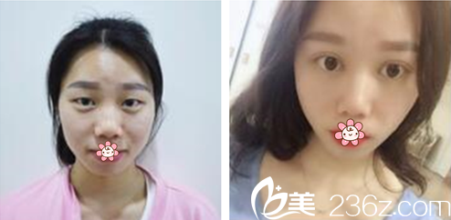 姜哲旭院长双眼皮案例 姜哲旭院长双眼皮案例