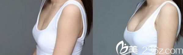 吉基贤院长自体隆胸效果案例 吉基贤院长自体隆胸效果案例