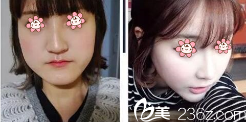 孙佑佶院长面部轮廓案例 孙佑佶院长面部轮廓案例