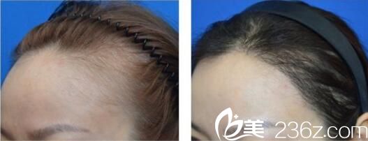 韩国洪承哲整形外科洪承哲发际线种植真人案例术前术后对比