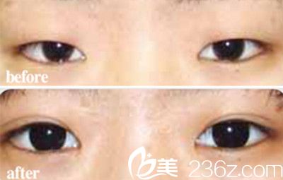 韩国延世罗姿丽整形医院双眼皮手术案例