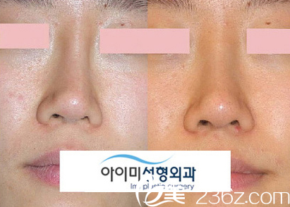 韩国爱美（IMI）整形医院歪鼻矫正案例对比图