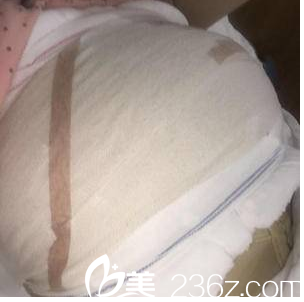 在<!--<i data=20240703-sp></i>-->做脂肪丰胸第2天效果 在<!--<i data=20240703-sp></i>-->做脂肪丰胸第2天效果