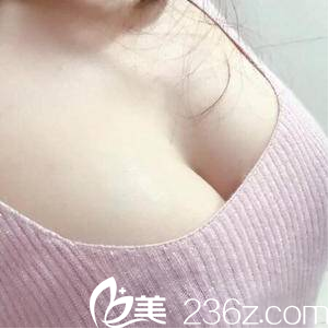 <!--<i data=20240703-sp></i>-->脂肪丰胸案例第31天效果 <!--<i data=20240703-sp></i>-->脂肪丰胸案例第31天效果