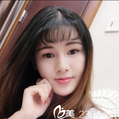 <!--<i data=20240703-sp></i>-->整形医院陈瑞红面部线雕提升两个月效果图 <!--<i data=20240703-sp></i>-->整形医院陈瑞红面部线雕提升两个月效果图