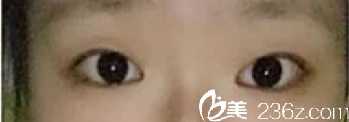 Channel整形医院手术前 Channel整形医院手术前