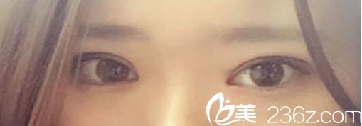 双眼皮+内开眼角术后效果 双眼皮+内开眼角术后效果