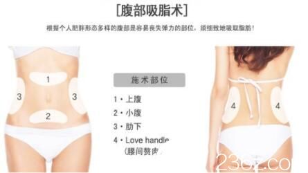 美莱美容医院腰腹吸脂术 美莱美容医院腰腹吸脂术