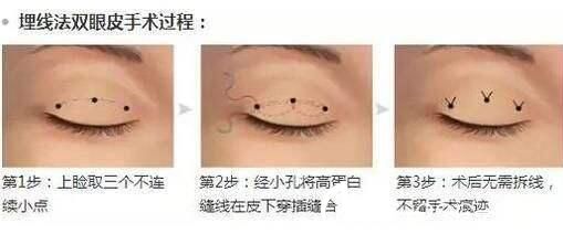 美莱美容医院杨继红埋线双眼皮